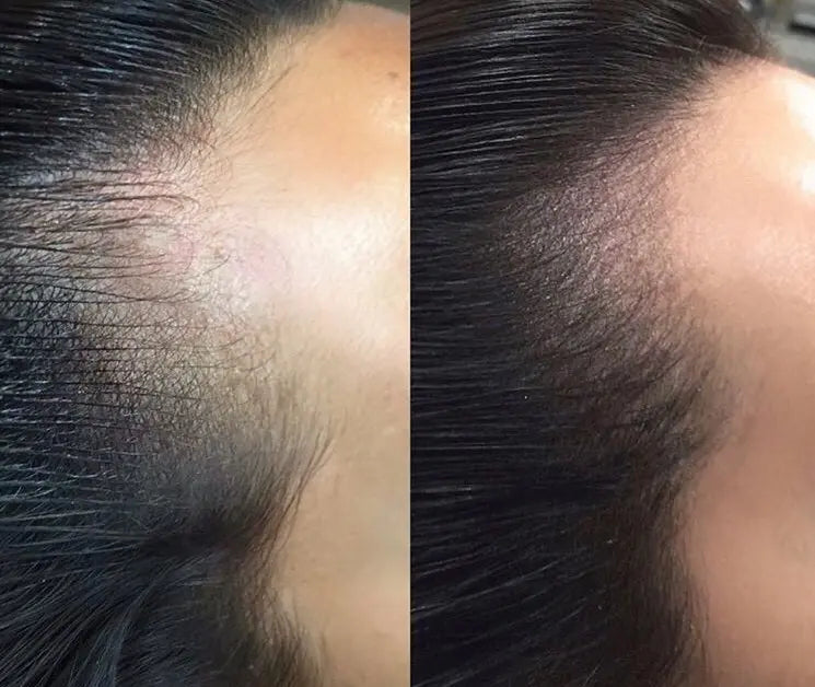 Scalp Micropigmentation (price is specified per session)
