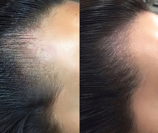 Scalp Micropigmentation (price is specified per session)